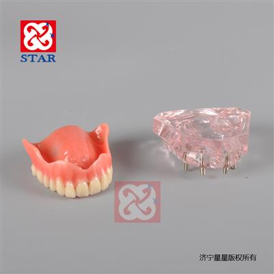 4個(gè)微型種植釘，上頜一尺修復(fù)。M6001